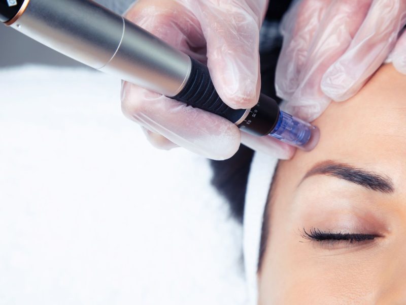 Dermapen Facial