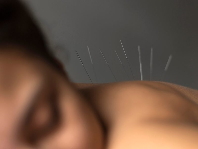 Acupuntura