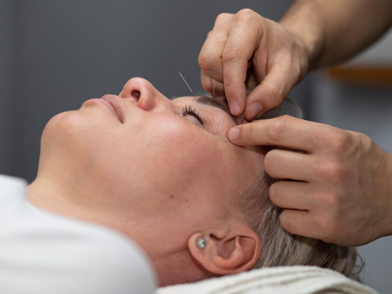Acupuntura Estética Facial